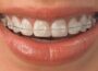 lingual braces?